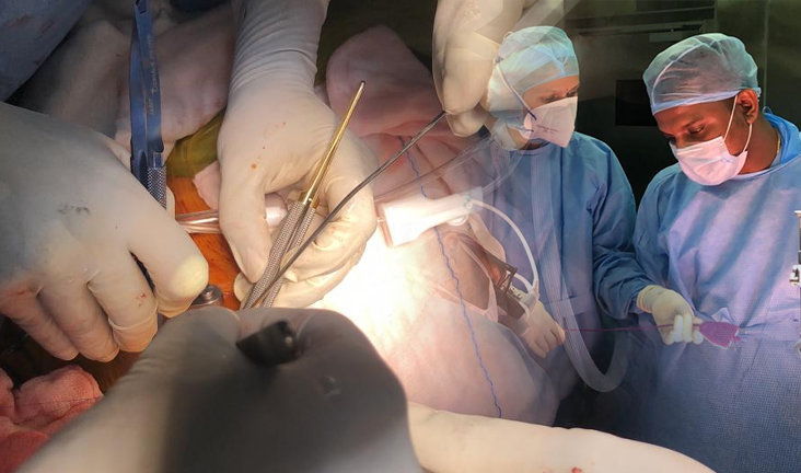 Multivessel MICS CABG AND VALVE Surgery