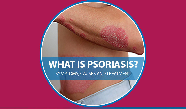 Psoriasis : Symptoms, Causes and Treatment