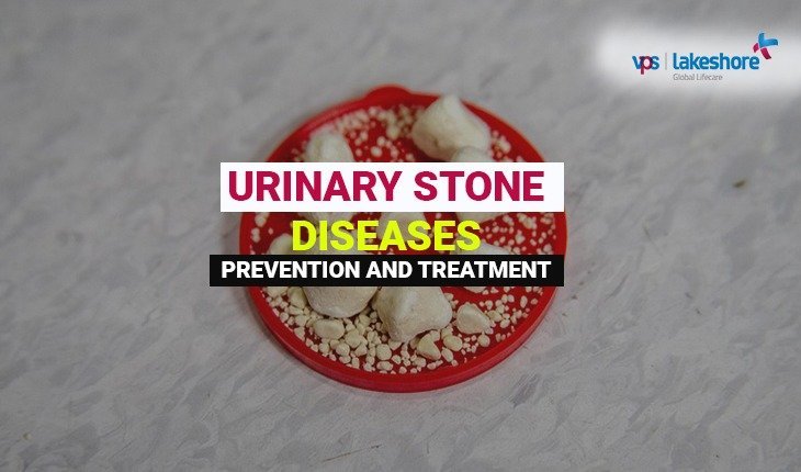 Urinary stone disease and management